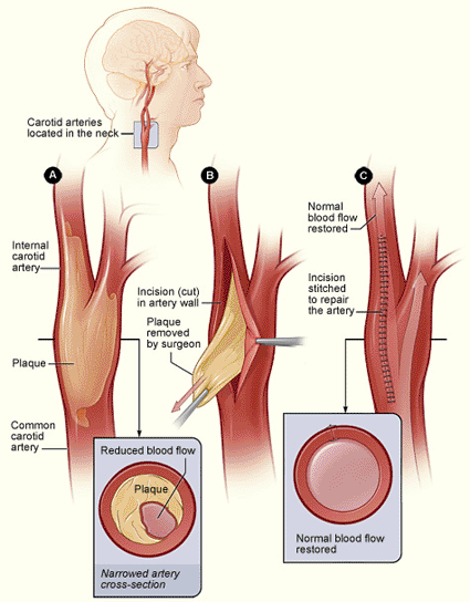 Imagen: Diagrama muestra placa arteroesclerótica extraida de la arteria carótida para restaurar flujo de sangre al cerebro (Foto cortesía de NIH / NHLBI). Imagen: Diagrama muestra placa arteroesclerótica extraida de la arteria carótida para restaurar flujo de sangre al cerebro (Foto cortesía de NIH / NHLBI).